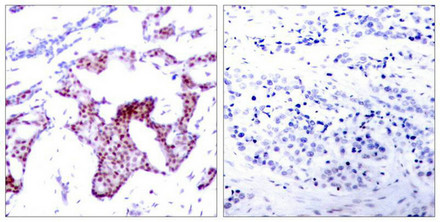 Immunohistochemical analysis of paraffin-embedded human breast carcinoma tissue using NFkappa;B-p65 (Phospho-Ser276) Antibody (left) or the same antibody preincubated with blocking peptide (right).
