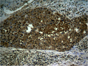 Immunohistochemical analysis of paraffin- embedded human breast carcinoma tissue using NFkappa;B-p65 (Phospho-Ser276) antibody.