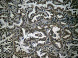 Immunohistochemical analysis of paraffin- embedded human lung carcinoma tissue using NFkappa;B-p65 (Phospho-Ser276) antibody.