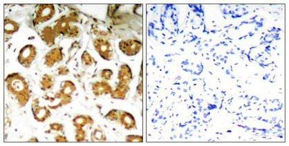 Immunohistochemical analysis of paraffin-embedded human breast carcinoma tissue using NFkB-p65(Ab-505) Antibody(left) or the same antibody preincubated with blocking peptide(right). Immunohistochemical analysis of paraffin-embedded human breast carcinoma tissue using NFkB-p65(Ab-505) Antibody(left) or the same antibody preincubated with blocking peptide(right).