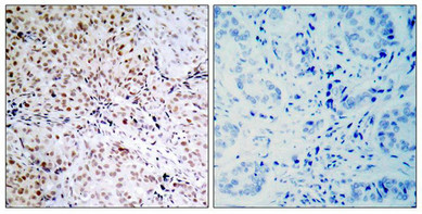Immunohistochemical analysis of paraffin-embedded human breast carcinoma tissue using Rb(Phospho-Ser795) Antibody(left) or the same antibody preincubated with blocking peptide(right).