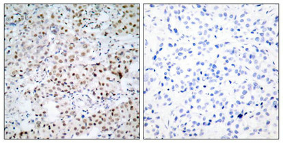 Immunohistochemical analysis of paraffin-embedded human breast carcinoma tissue using CREB(Ab-133) Antibody(left) or the same antibody preincubated with blocking peptide(right).