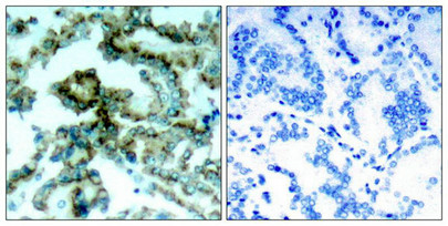 Immunohistochemical analysis of paraffin-embedded human lung carcinoma tissue, using PKCb(phospho-Thr641) antibody.