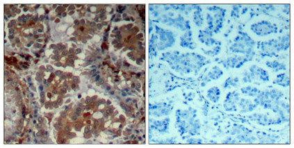 Immunohistochemical analysis of paraffin-embedded human Lung carcinoma tissue using mTOR(Ab-2448) Antibody(left) or the same antibody preincubated with blocking peptide(right).
