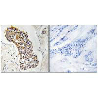 Immunohistochemistry analysis of paraffin-embedded human breast carcinoma tissue, using HSD11B1 antibody.