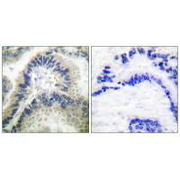 Immunohistochemical analysis of paraffin-embedded human lung carcinoma tissue using Guanylate Cyclase beta antibody.
