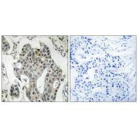 Immunohistochemistry analysis of paraffin-embedded human breast carcinoma tissue using RAB3GAP2 antibody.