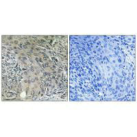 Immunohistochemistry analysis of paraffin-embedded human cervix carcinoma tissue using COPZ1 antibody.