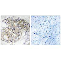 Immunohistochemistry analysis of paraffin-embedded human breast carcinoma tissue, using DHRS4 antibody.