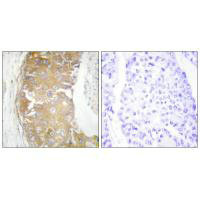 Immunohistochemistry analysis of paraffin-embedded human breast carcinoma tissue using FRK antibody.