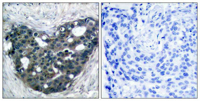Immunohistochemical analysis of paraffin-embedded human breast carcinoma tissue using p56Dok-2(Ab-299) Antibody(left) or the same antibody preincubated with blocking peptide(right).