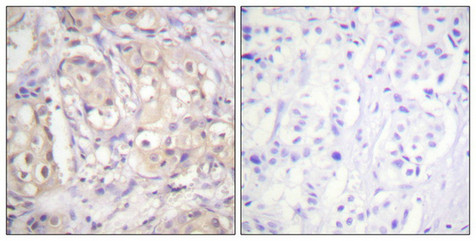 Immunohistochemical analysis of paraffin-embedded human breast carcinoma tissue using B-Raf (Phospho-Thr598) antibody (left)or the same antibody preincubated with blocking peptide (right). Immunohistochemical analysis of paraffin-embedded human breast carcinoma tissue using B-Raf (Phospho-Thr598) antibody (left)or the same antibody preincubated with blocking peptide (right).