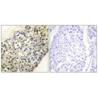 Immunohistochemistry analysis of paraffin-embedded human breast carcinoma tissue, using LATH antibody. Immunohistochemistry analysis of paraffin-embedded human breast carcinoma tissue, using LATH antibody.