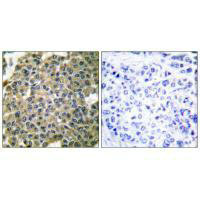 Immunohistochemical analysis of paraffin-embedded human breast carcinoma tissue using Keratin 7 antibody. Immunohistochemical analysis of paraffin-embedded human breast carcinoma tissue using Keratin 7 antibody.
