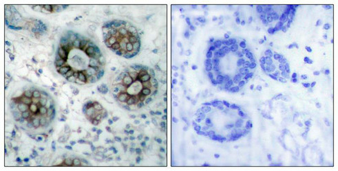 Immunohistochemical analysis of paraffin-embedded human breast carcinoma tissue using GAP43(Ab-41) Antibody(left) or the same antibody preincubated with blocking peptide(right).
