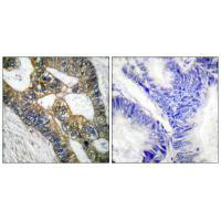 Immunohistochemical analysis of paraffin-embedded human colon carcinoma tissue using MMP-7 antibody. Immunohistochemical analysis of paraffin-embedded human colon carcinoma tissue using MMP-7 antibody.
