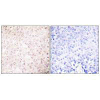 Immunohistochemical analysis of paraffin-embedded human breast carcinoma tissue using P300/CBP antibody.