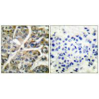 Immunohistochemical analysis of paraffin-embedded human breast carcinoma tissue using Granzyme B antibody.