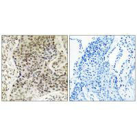 Immunohistochemistry analysis of paraffin-embedded human lung carcinoma tissue, using TSEN54 antibody.