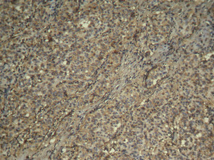 Immunohistochemical analysis of paraffin-embedded human breast carcinoma tissue usingCDK4 Antibody.