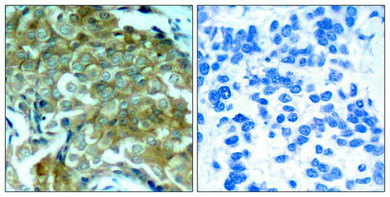 Immunohistochemical analysis of paraffin-embedded human breast carcinoma tissue using EGFR(Phospho-Tyr1172) Antibody(left) or the same antibody preincubated with blocking peptide(right).