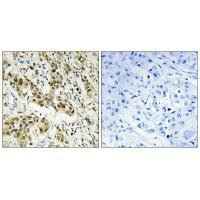 Immunohistochemistry analysis of paraffin-embedded human breast carcinoma tissue using CtBP1 (Ab-422) antibody.