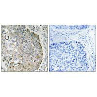 Immunohistochemistry analysis of paraffin-embedded human lung carcinoma tissue, using MRRF antibody.