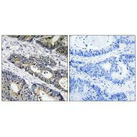 Immunohistochemistry analysis of paraffin-embedded human colon carcinoma tissue using GLB1L3 antibody. Immunohistochemistry analysis of paraffin-embedded human colon carcinoma tissue using GLB1L3 antibody.
