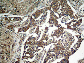 Immunohistochemical analysis of paraffin-embedded human lung carcinoma tissue, using eIF2alpha (Phospho-Ser51) Antibody.