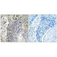 Immunohistochemistry analysis of paraffin-embedded human lung carcinoma tissue, using SLC28A2 antibody.