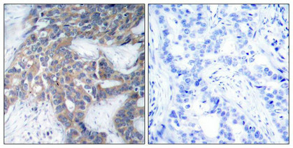 Immunohistochemical analysis of paraffin-embedded human breast carcinoma tissue using MEK1/MEK2(Phospho-Ser217/Ser221) Antibody(left) or the same antibody preincubated with blocking peptide(right).