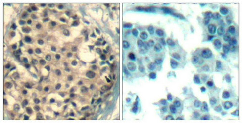 Immunohistochemical analysis of paraffin-embedded human breast carcinoma tissue using HDAC4/HDAC5/HDAC9(Phospho-Ser246/259/220) Antibody(left) or the same antibody preincubated with blocking peptide(right).
