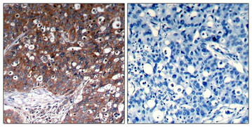 Immunohistochemical analysis of paraffin-embedded human breast carcinoma tissue using IGF-1R(Ab-1280) Antibody(left) or the same antibody preincubated with blocking peptide(right).