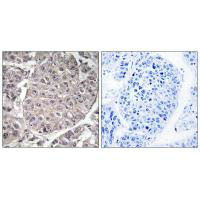 Immunohistochemistry analysis of paraffin-embedded human liver carcinoma tissue using APOL4 antibody.