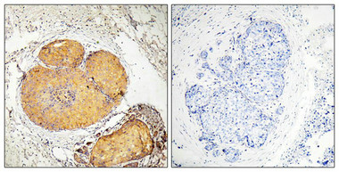 Immunohistochemical analysis of paraffin-embedded human breast carcinoma tissue, using FADD (Phospho-Ser190) antibody (left)or the same antibody preincubated with blocking peptide (right).