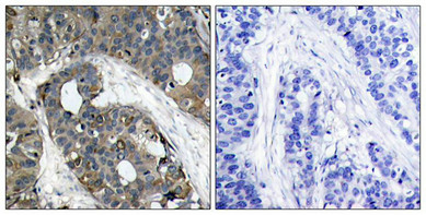 Immunohistochemical analysis of paraffin-embedded human breast carcinoma tissue using HSP27(Ab-82) Antibody(left) or the same antibody preincubated with blocking peptide(right).