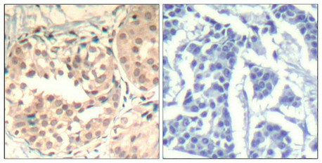 Immunohistochemical analysis of paraffin-embedded human breast carcinoma tissue using CDK6(Phospho-Tyr13) Antibody(left) or the same antibody preincubated with blocking peptide(right).