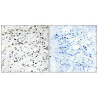Immunohistochemistry analysis of paraffin-embedded human breast carcinoma tissue using ELOA1 antibody.