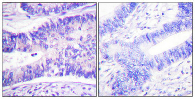 Immunohistochemistry analysis of paraffin-embedded human colon carcinoma tissue using WAVE1 (Phospho-Tyr125) antibody. The picture on the right is treated with the synthesized peptide.