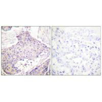 Immunohistochemical analysis of paraffin-embedded human breast carcinoma tissue using CARD6 antibody.