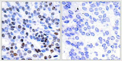 Immunohistochemical analysis of paraffin-embedded human breast carcinoma tissue using JunB(Ab-259) Antibody(left) or the same antibody preincubated with blocking peptide(right).