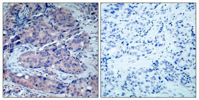 Immunohistochemical analysis of paraffin-embedded human breast carcinoma tissue using SEK1/MKK4(Ab-261) Antibody(left) or the same antibody preincubated with blocking peptide(right). Immunohistochemical analysis of paraffin-embedded human breast carcinoma tissue using SEK1/MKK4(Ab-261) Antibody(left) or the same antibody preincubated with blocking peptide(right).