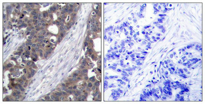 Immunohistochemical analysis of paraffin-embedded human breast carcinoma tissue using p70 S6 Kinase(Ab-411) Antibody(left) or the same antibody preincubated with blocking peptide(right).