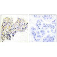 Immunohistochemical analysis of paraffin-embedded human breast carcinoma tissue using HSP90B (Ab-254) antibody. Immunohistochemical analysis of paraffin-embedded human breast carcinoma tissue using HSP90B (Ab-254) antibody.
