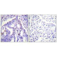 Immunohistochemistry analysis of paraffin-embedded human lung carcinoma tissue using PIAS4 antibody. Immunohistochemistry analysis of paraffin-embedded human lung carcinoma tissue using PIAS4 antibody.