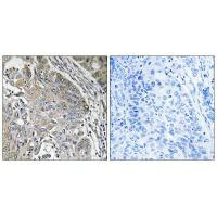 Immunohistochemistry analysis of paraffin-embedded human lung carcinoma tissue using SPINK6 antibody. Immunohistochemistry analysis of paraffin-embedded human lung carcinoma tissue using SPINK6 antibody.