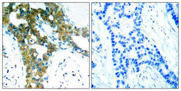 Immunohistochemical analysis of paraffin-embedded human breast carcinoma tissue using PAK1/PAK2/PAK3(Ab-423/402/421) Antibody(left) or the same antibody preincubated with blocking peptide(right).