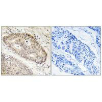 Immunohistochemistry analysis of paraffin-embedded human lung carcinoma tissue, using ALS2CR8 antibody.