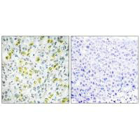 Immunohistochemistry analysis of paraffin-embedded human liver carcinoma tissue, using CHD4 antibody. Immunohistochemistry analysis of paraffin-embedded human liver carcinoma tissue, using CHD4 antibody.
