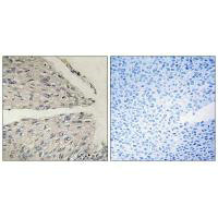 Immunohistochemistry analysis of paraffin-embedded human cervix carcinoma tissue using CIDEB antibody.